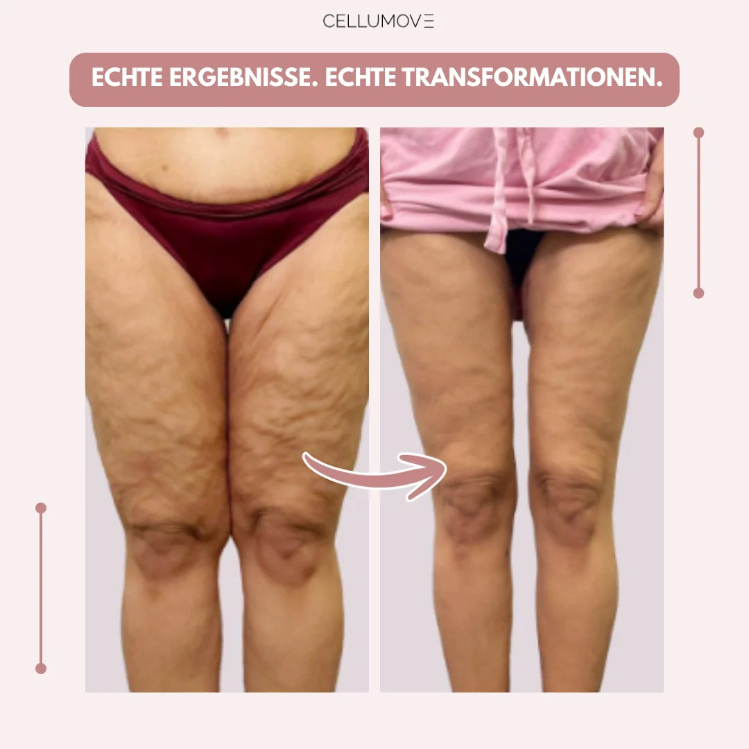 Cellumove 3D Legging – Verabschieden Sie sich auf natürliche Weise von den Schmerzen und Schwellungen des Lipödems